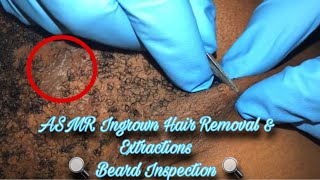 Ingrown Hair Removal amp Extractions Pt 10 🔍 Neck amp Beard Area ASMR Slight Talking [upl. by Jerold]