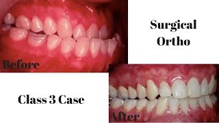 Surrgical Ortho Cl 3 type [upl. by Denys]