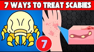 7 Best Ways To Treat Scabies Faster Get relief from itch [upl. by Haberman]