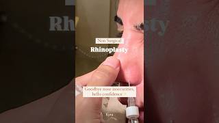 Non surgical nose job rhinoplasty filler cosmetic surgery non surgical botox beautyshorts viral [upl. by Aeneg]