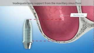 Sinus floor elevation Dental Animation [upl. by Ellevel]