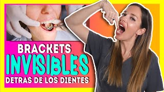 🔥Arregla tus 𝑫𝑰𝑬𝑵𝑻𝑬𝑺 𝑻𝑶𝑹𝑪𝑰𝑫𝑶𝑺 𝒔𝒊𝒏 𝑩𝑹𝑨𝑪𝑲𝑬𝑻𝑺 tradicionales Ortodoncia LINGUAL con BRACKETS INVISIBLES [upl. by Abisha951]