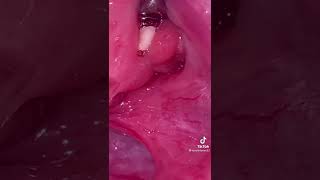 Removal of Tonsil stones [upl. by Nylauqcaj]