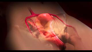 Dr Harris Narrates A 3D Animation of a Uterine Fibroid Embolization UFE [upl. by Hpesoj]