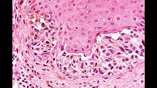 Atypical nevi Part 1 Neonatal nevi and nevus of specal sites Phillip H McKee [upl. by Petula]