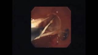 Endoscopic Removal of Foreign Bodies in the Upper GI Tract DV021 [upl. by Dehlia638]