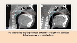 Palate widening with orthodontics reduces the size of adenoids and tonsils in children [upl. by Enilehcim389]