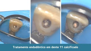 Endodontia Microscópica Avançada  Tratamento endodôntico de dente 11 calcificado [upl. by Notnroht]