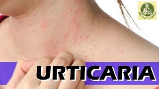 Urticaria – Remedios caseros para la urticaria  Urticaria en la piel [upl. by Cyprus]