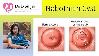 Nabothian cysts HINDI [upl. by Rothmuller]