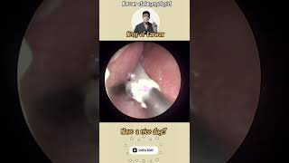 귀지형 콧물 부비동염 축농증 비염 코청소 이비인후과 rhinorrhea rhinitis sinusitis ASMR [upl. by Bohun718]