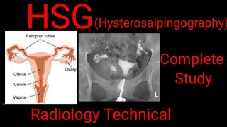 HSG  Hysterosalpingography Complete study Radiology technical  by BL Kumawat [upl. by Virg757]