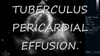 TUBERCULUS PERICARDIAL EFFUSION  ECHOCARDIOGRAPHY SERIES BY DR ANKUR K CHAUDHARI [upl. by Calli93]