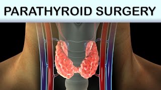 Parathyroid Surgery Medical Animation [upl. by Yt885]