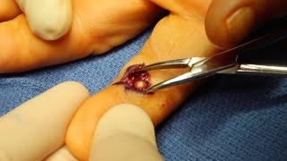 Live Surgery Foreign Body BB Removal from Finger [upl. by Kissie]