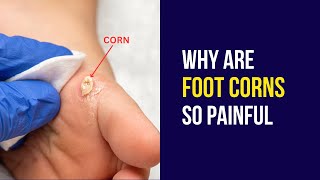 Why are Foot Corns so Painful [upl. by Rheta]