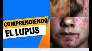 quotComprendiendo el Lupus Síntomas Diagnóstico y Tratamientoquot [upl. by Eceinhoj209]