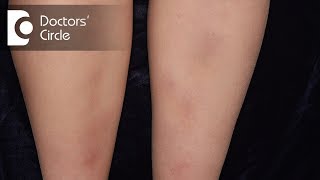 How to manage Lichen Planus present in the legs  Dr Rajdeep Mysore [upl. by Feetal]