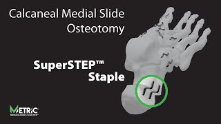 Calcaneal Medial Slide Osteotomy Video [upl. by Harl]