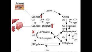 Galactosemia Galactose metabolism disorder [upl. by Gilba789]