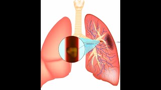 Pulmonary Embolism [upl. by Nonnarb414]