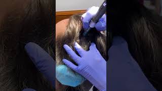 Microneedling for hair loss for scalp PRP microneedling hairlosstreatment [upl. by Alleinnad906]