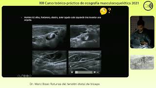 2021 Formas ecográficas de las roturas del tendón distal biceps marc blasi [upl. by Yelda]