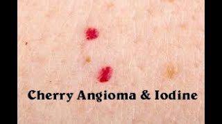 Cherry Angiomas and Iodine [upl. by Raab]