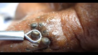 Big Big Comedones blackhead popping ever blackhead removal most satisfying blackheads extraction [upl. by Christean]