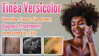 Tinea versicolor overview causes sign and symptoms diagnosis treatment home remedies and FAQs [upl. by Ytteb883]