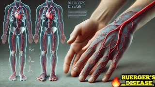 Buergers Disease Thromboangiitis Obliterans Easy Explanation [upl. by Ballman]