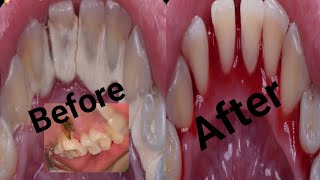 Tartar removed from teeth secret of teeth cleaning [upl. by Porte]