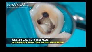 removal fractured broken endodontic file with ultrasonic tip ET 18 D et 20 satelec mandibular molar [upl. by Nitsir]