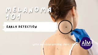 Early Detection of Melanoma [upl. by Pavla]