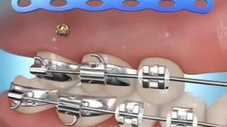 orthodontic mini implant زرعات ميني امبلانت تقويمية [upl. by Kimbra]