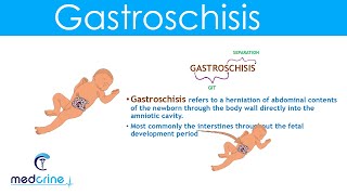 Gastroschisis Definition Causes and Diferences with Omphalocele [upl. by Tiphanie430]