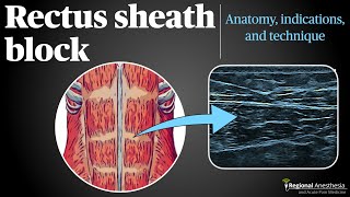 Rectus Sheath Block [upl. by Oeht118]