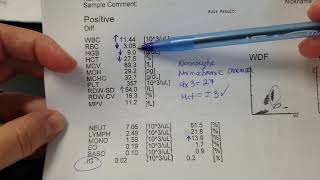 Hematology How to interpret automated Complete Blood Count CBC results [upl. by Carilyn]