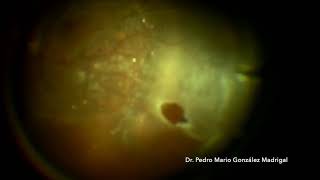 Vitrectomy for Rhegmatogenous Retinal detachment with PVR [upl. by Adiela]