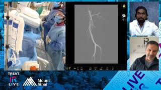 Transradial Genicular Artery Embolization GAE for Knee Osteoarthritis OA [upl. by Yatnohs]