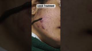 Leech Treatment for Pimples  Ayurawa Ayurveda  DrGayathri Kooragoda leechtherapy raktamokshana [upl. by Wald]