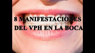 8 manifestaciones de VPH en la boca [upl. by Furtek523]