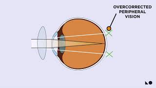 How OrthoK Works amp How It Slows Myopia [upl. by Elyssa679]