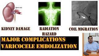 Complications of Varicocele Embolization  Microsurgery vs Embolization for Varicocele [upl. by Meaghan297]