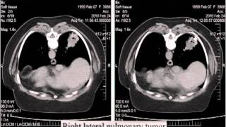 CT guided punctures [upl. by Hesler]