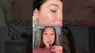 acne transformation through accutane check out my Accutane vid for more info like side effects [upl. by Jolee]