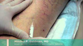 Sclerotherapy For Leg Veins  Mitchel P Goldman MD  San Diego [upl. by Ylecara]