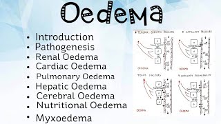 Oedema Pathology [upl. by Hy90]