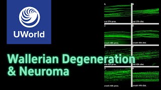 Wallerian degeneration amp neuroma  USMLE step 1 UWorld Questions Nervous system MBBS PLAB [upl. by Francis]