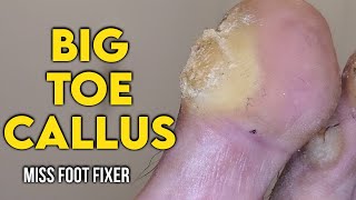 SHAVING OF REAL BIG TOE CALLUS 🦶 BIGGEST TOE CALLOUS EVER FULL TREATMENT BY MISS FOOT FIXER [upl. by Anissej]